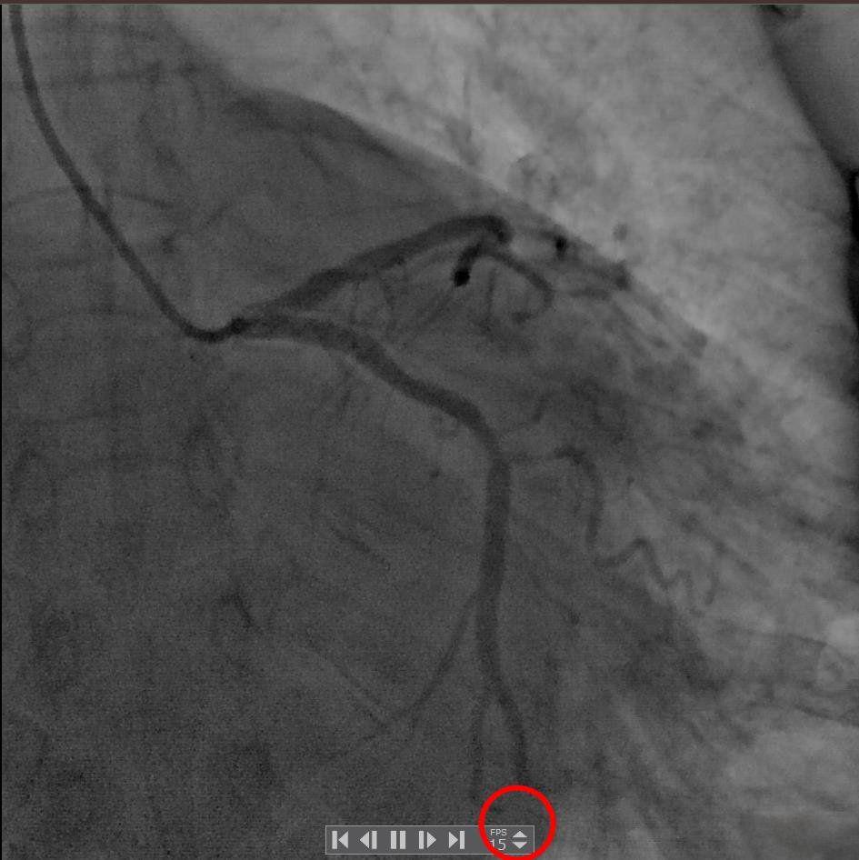 心脏造影视频播放器RadiAnt DICOM Viewer / Dicom Viewer_v2025.1 / v3.0.28.1210